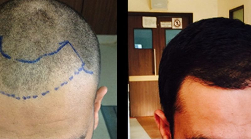 HAIR TRANSPLANT IN TURKEY